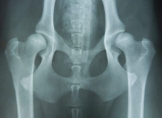 hip dysplasia