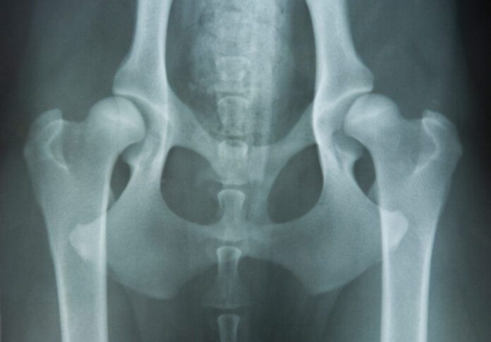 hip-dysplasia hip dysplasia