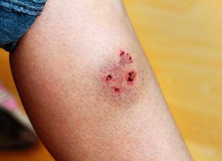 Are Dogs’ Mouths Cleaner Than Humans’? Woman's leg injured by a dog bite